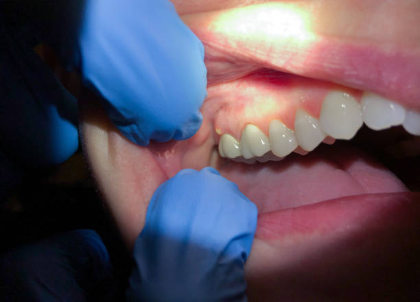Best Emergency Treatment for Toothache in Forty Fort, PA